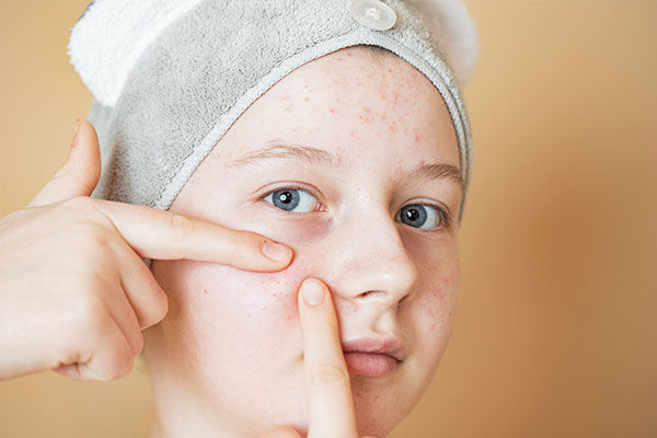 Acne & Teen Skin Issues