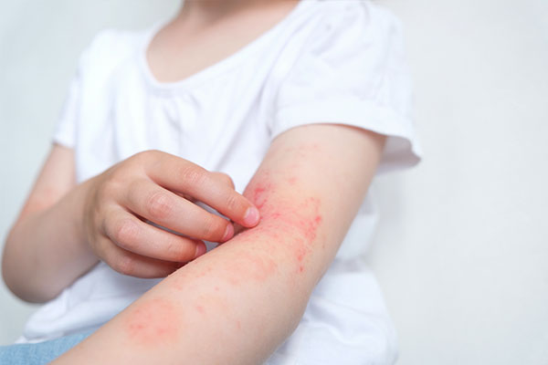 Allergic Skin Reactions