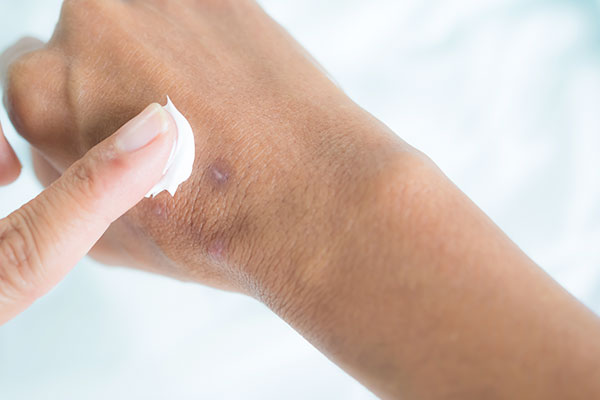 Bacterial Skin Infections