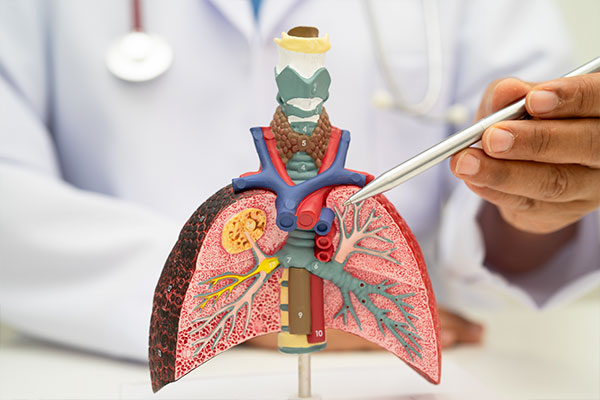 Bronchitis
