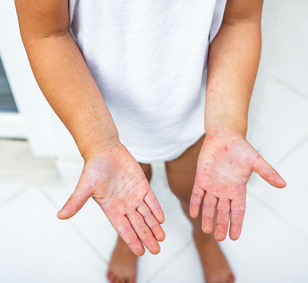 Common Symptoms of Child Skin Issues