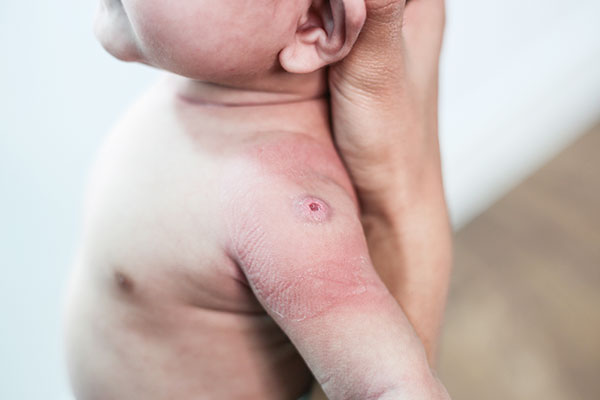 Eczema (Atopic Dermatitis)