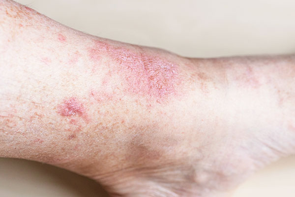 Fungal Infections