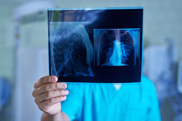 Pneumonia
