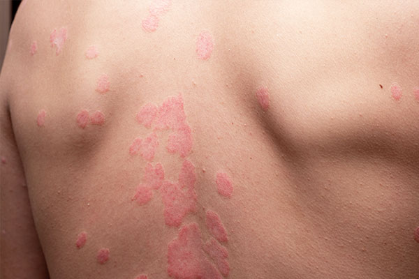 Psoriasis