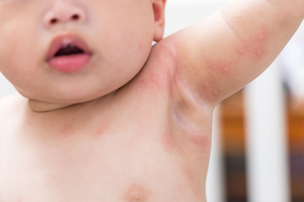 Viral Skin Conditions